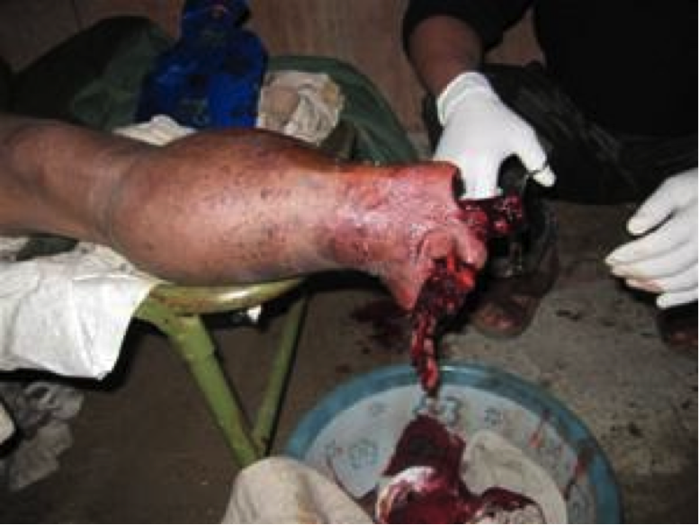 landmine victim