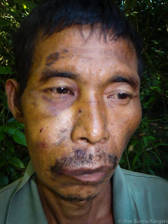 Ndau Gam, a Kachin villager tortured by Burma Army in November 2013.