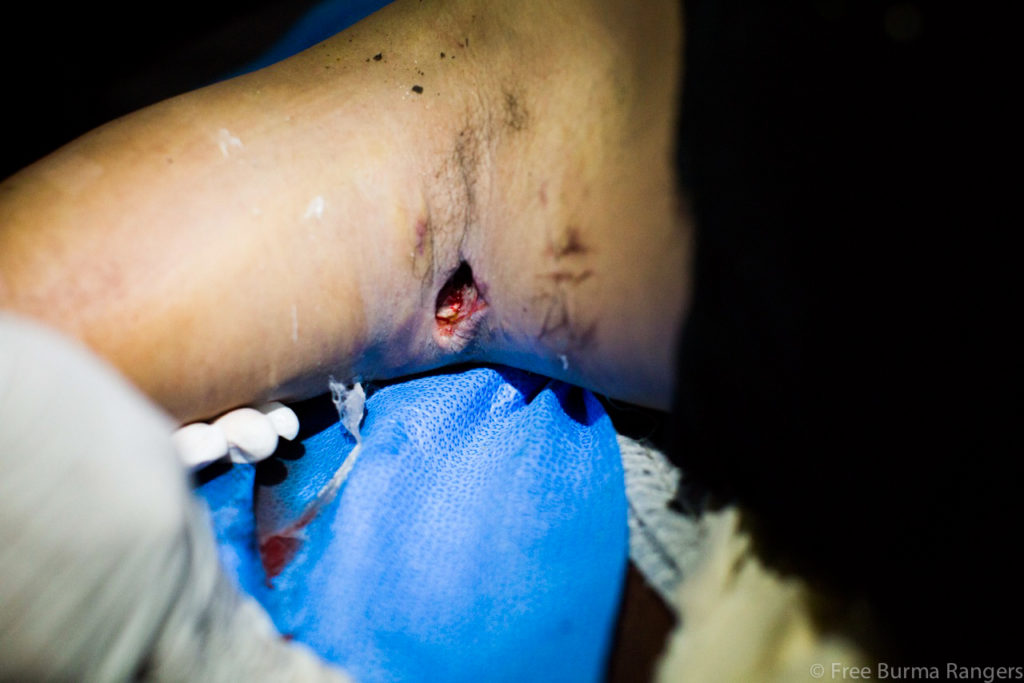 The exit wound from the bullet that hit Saw Shae Say while he was monitoring Burma Army activities in Karen State in February 2014.