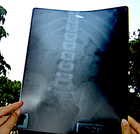 The x- ray of the bullet still in Naw Moo Day Wah
